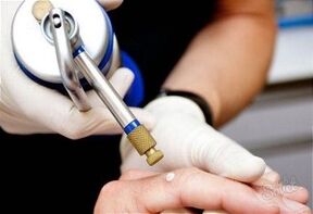 metode de îndepărtare a papiloamelor pielii