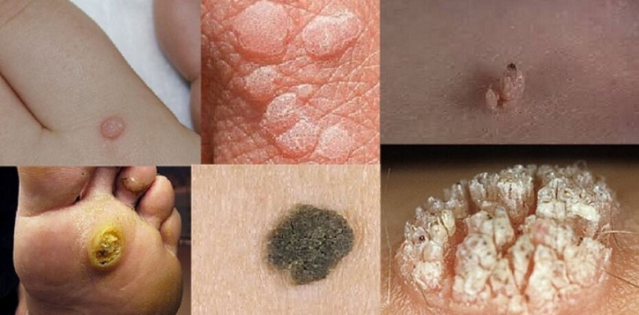 pielea parazitizează simptomele oamenilor